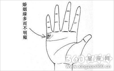 先天愚型通贯手图片6